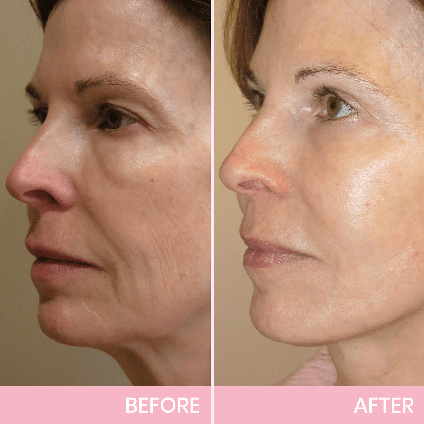 V-Face 👑 Invisible lifting tape