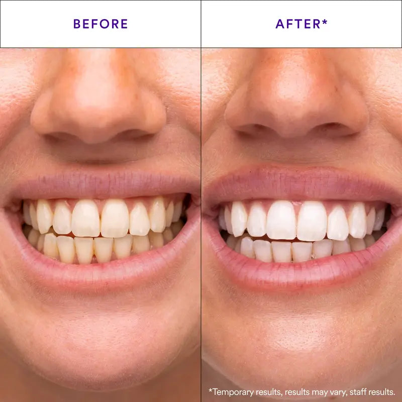 Hismile V34 Whitening Strips - Purple Teeth Whitening & Colour Correction